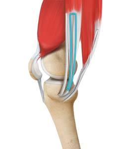 ACL Reconstruction Procedure of Hamstring Tendon