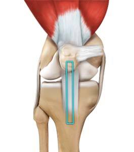 ACL Reconstruction (Patellar & Hamstring Tendon)