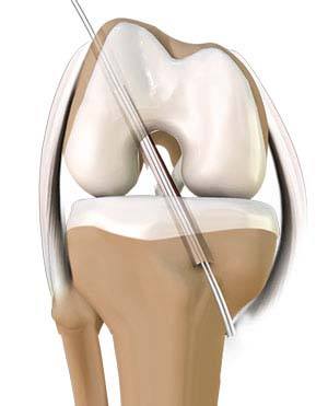 ACL Reconstruction (Patellar & Hamstring Tendon)