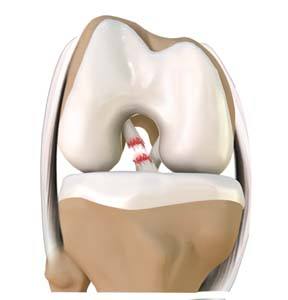 Anterior Cruciate Ligament (ACL) Tears