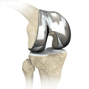 Knee Arthroplasty