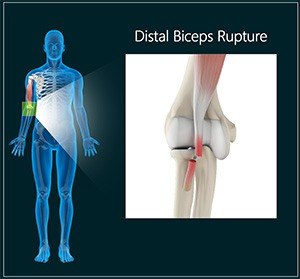 Distal Biceps Rupture