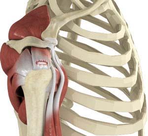 Rotator Cuff Tear