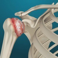 Shoulder Arthritis