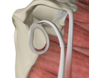 Shoulder Joint Tear (Glenoid Labrum Tear)