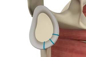 Shoulder Reconstruction