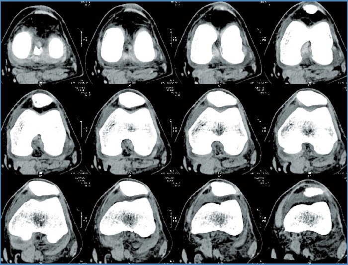 Knee CT Scan