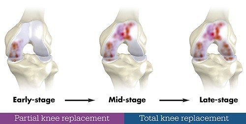 Partial Knee replacement