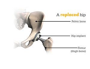 Replaced Hip